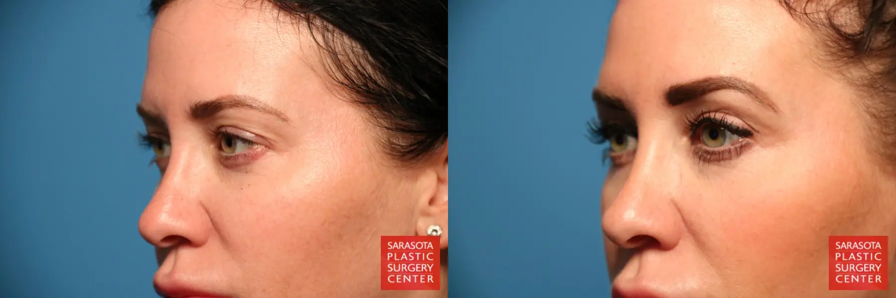 Blepharoplasty: Patient 11 - Before and After 4