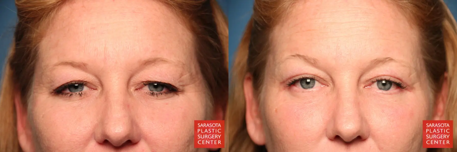 Blepharoplasty: Patient 4 - Before and After  