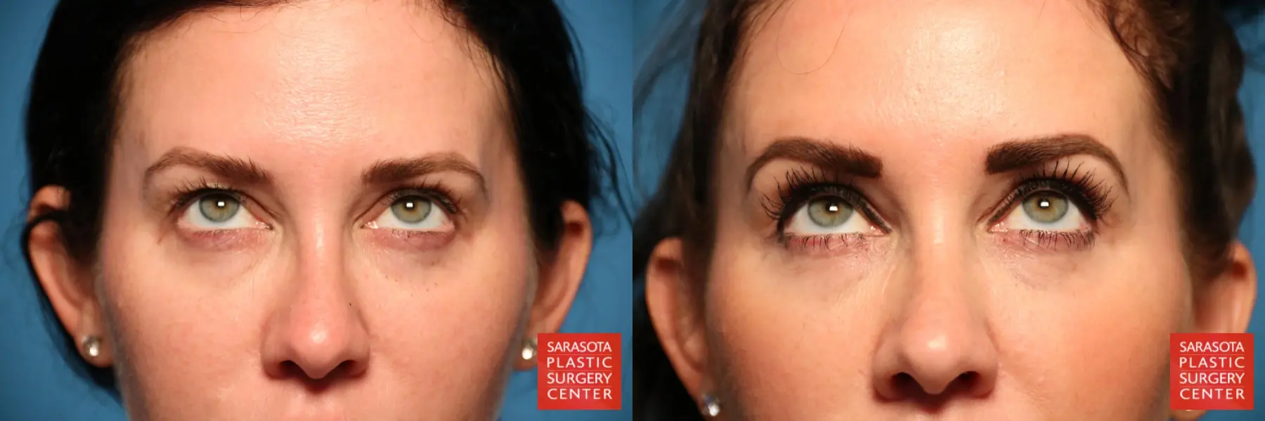 Blepharoplasty: Patient 11 - Before and After 3