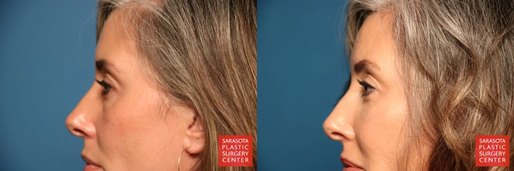 Blepharoplasty: Patient 8 - Before and After 3