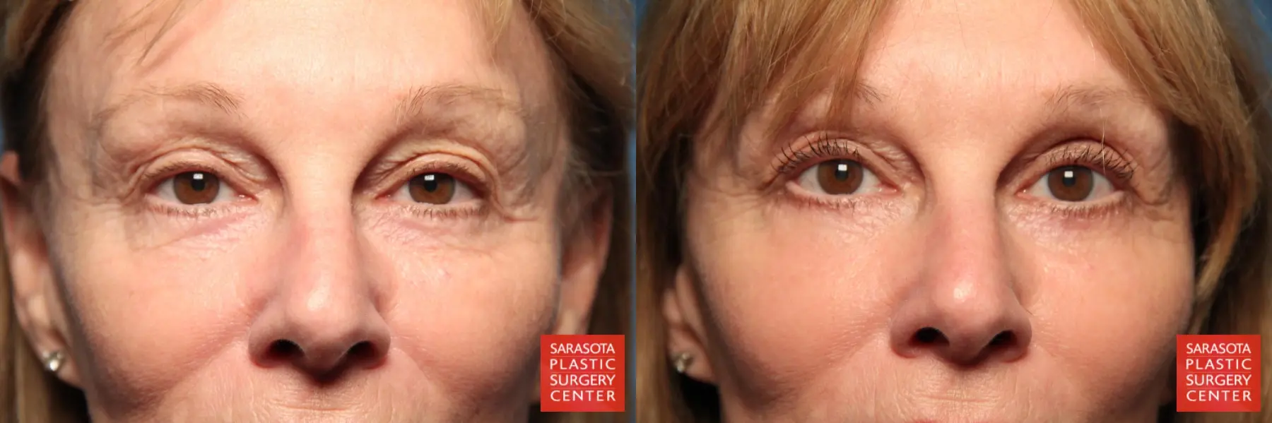 Blepharoplasty: Patient 11 - Before and After  