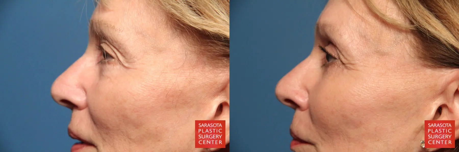Blepharoplasty: Patient 12 - Before and After 3