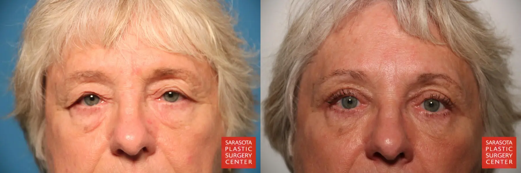 Blepharoplasty: Patient 7 - Before and After  