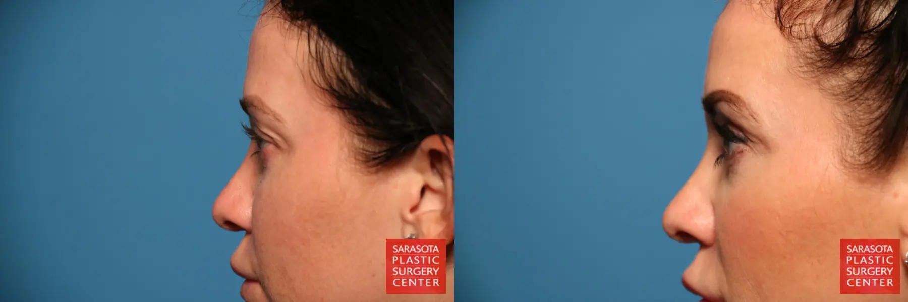Blepharoplasty: Patient 11 - Before and After 5
