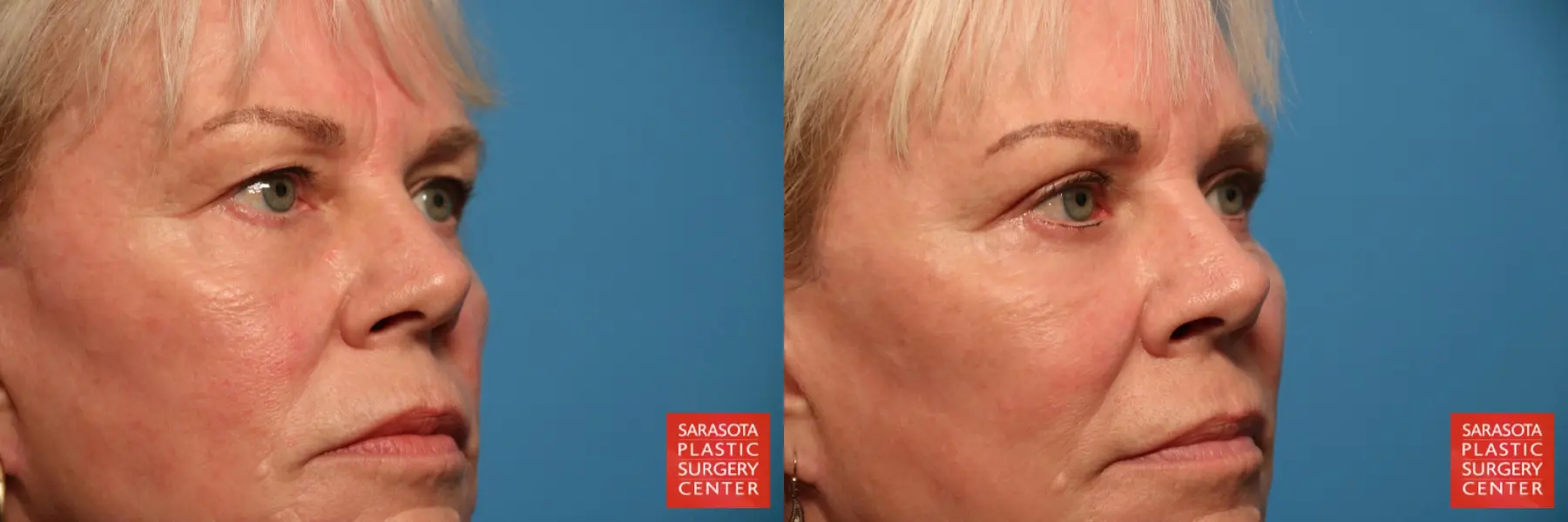 Blepharoplasty: Patient 25 - Before and After 6