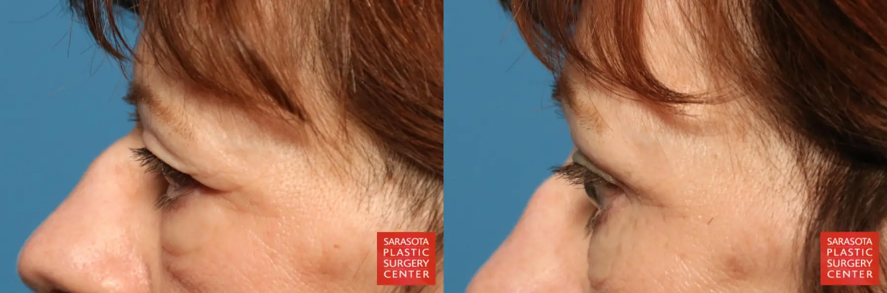 Blepharoplasty: Patient 15 - Before and After 5