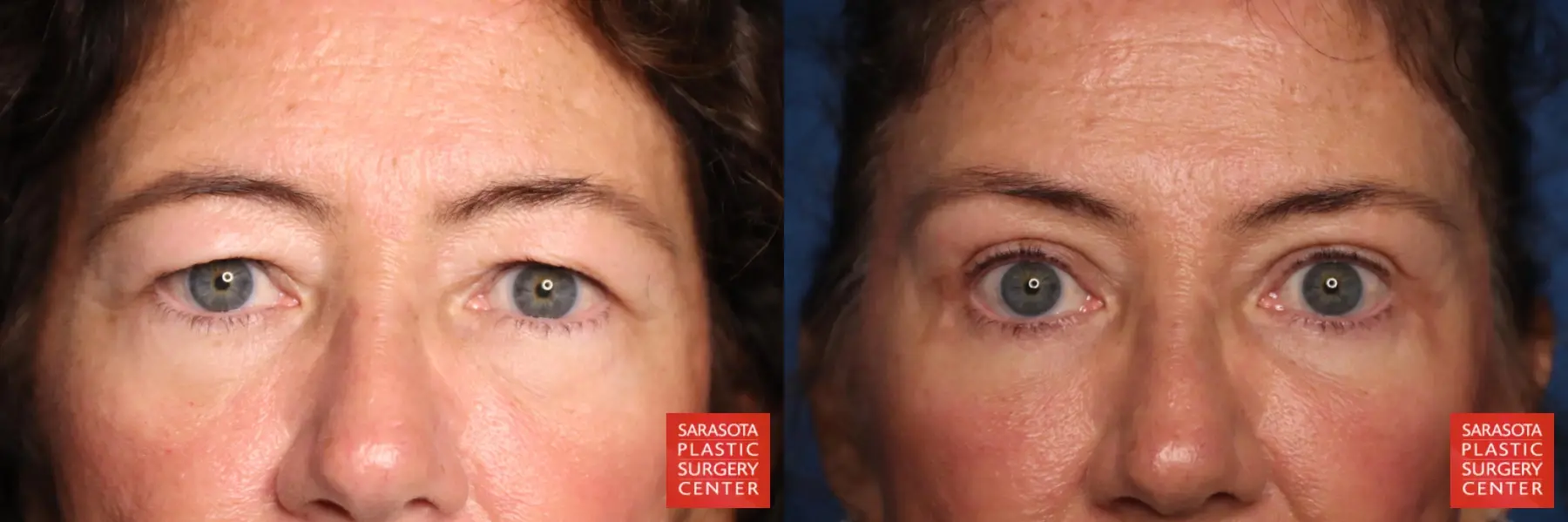 Blepharoplasty: Patient 30 - Before and After  