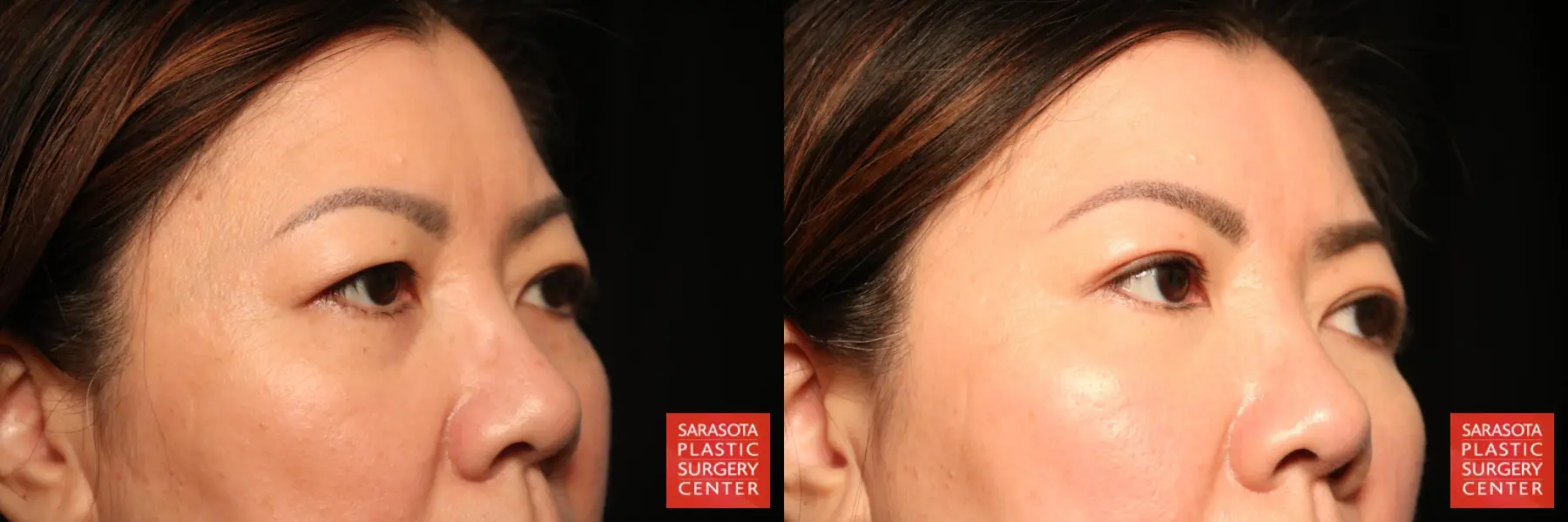 Blepharoplasty: Patient 27 - Before and After 3