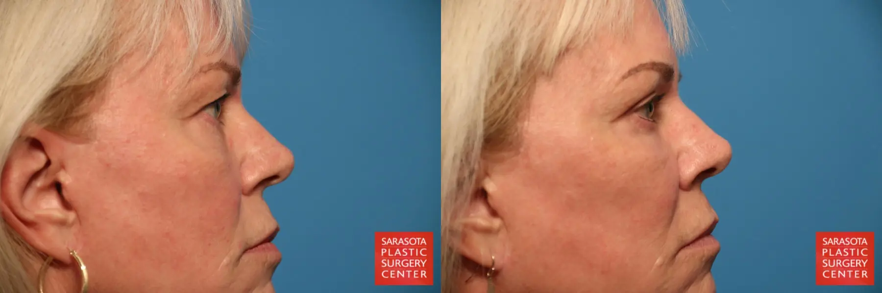 Blepharoplasty: Patient 25 - Before and After 7