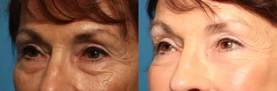 Blepharoplasty: Patient 23 - Before and After 3