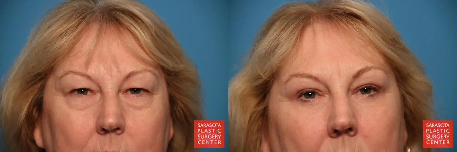 Blepharoplasty: Patient 21 - Before and After  