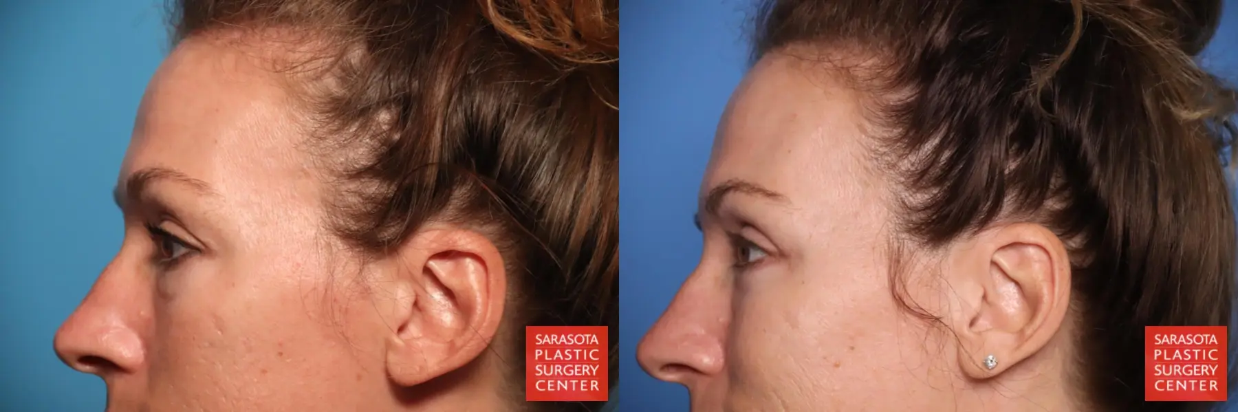 Blepharoplasty: Patient 44 - Before and After 4