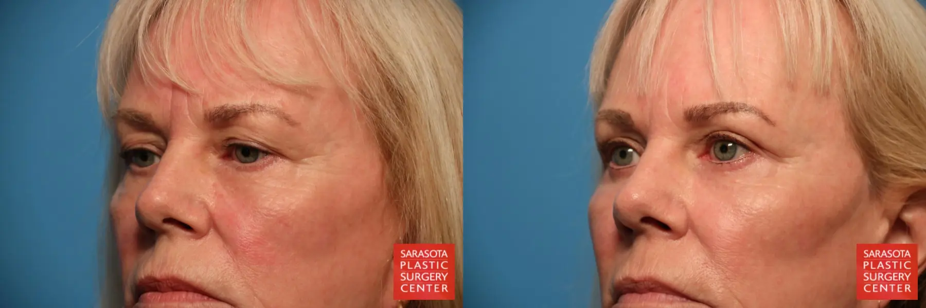 Blepharoplasty: Patient 25 - Before and After 4