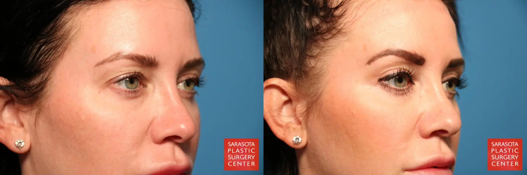 Blepharoplasty: Patient 11 - Before and After 6