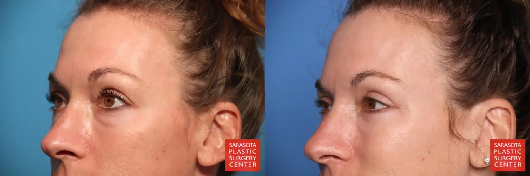 Blepharoplasty: Patient 44 - Before and After 3