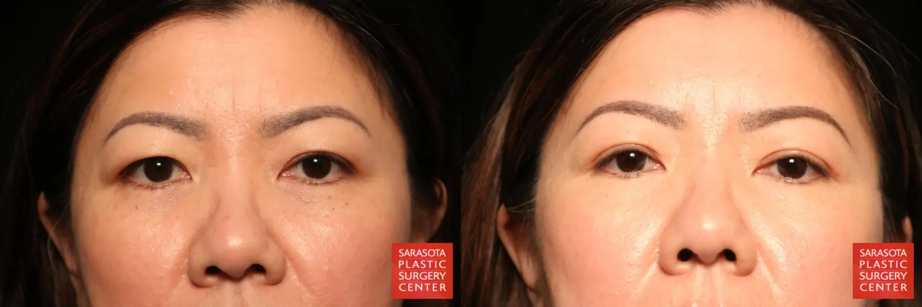 Blepharoplasty: Patient 27 - Before and After  