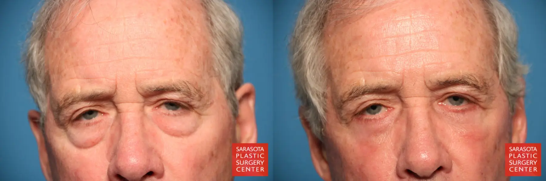 Blepharoplasty: Patient 16 - Before and After  