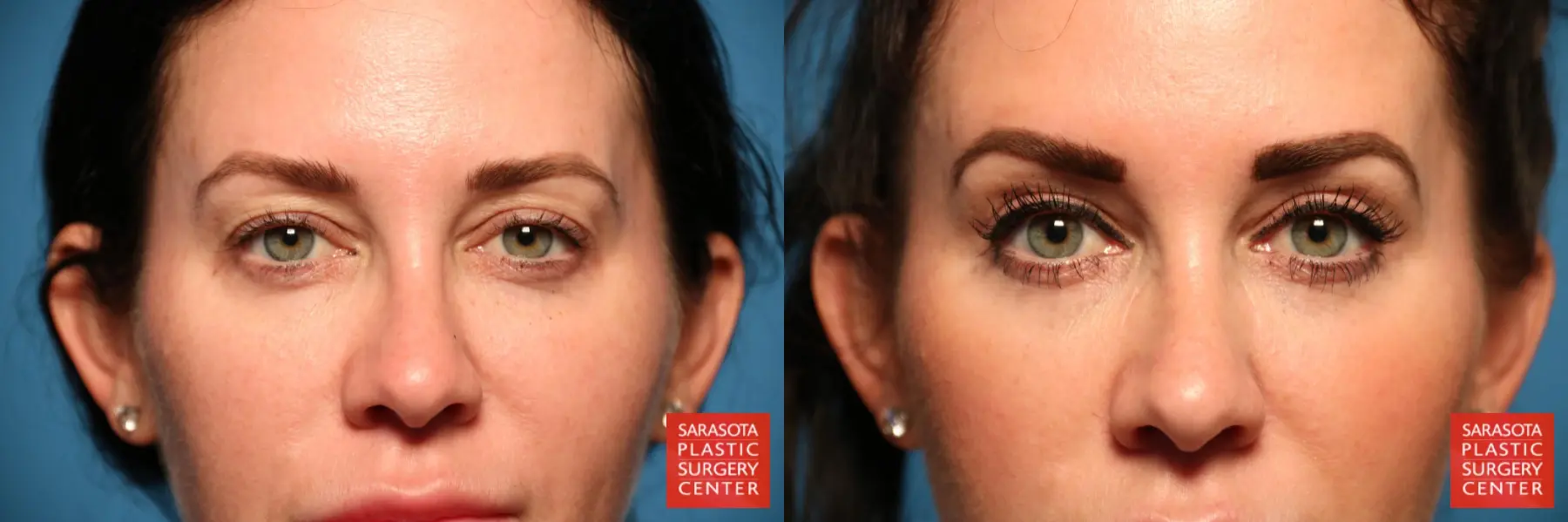 Blepharoplasty: Patient 10 - Before and After  