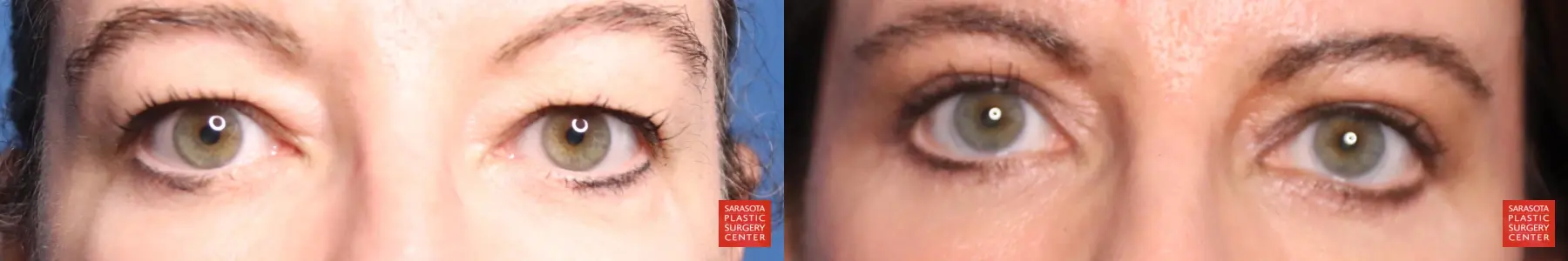 Blepharoplasty: Patient 30 - Before and After  