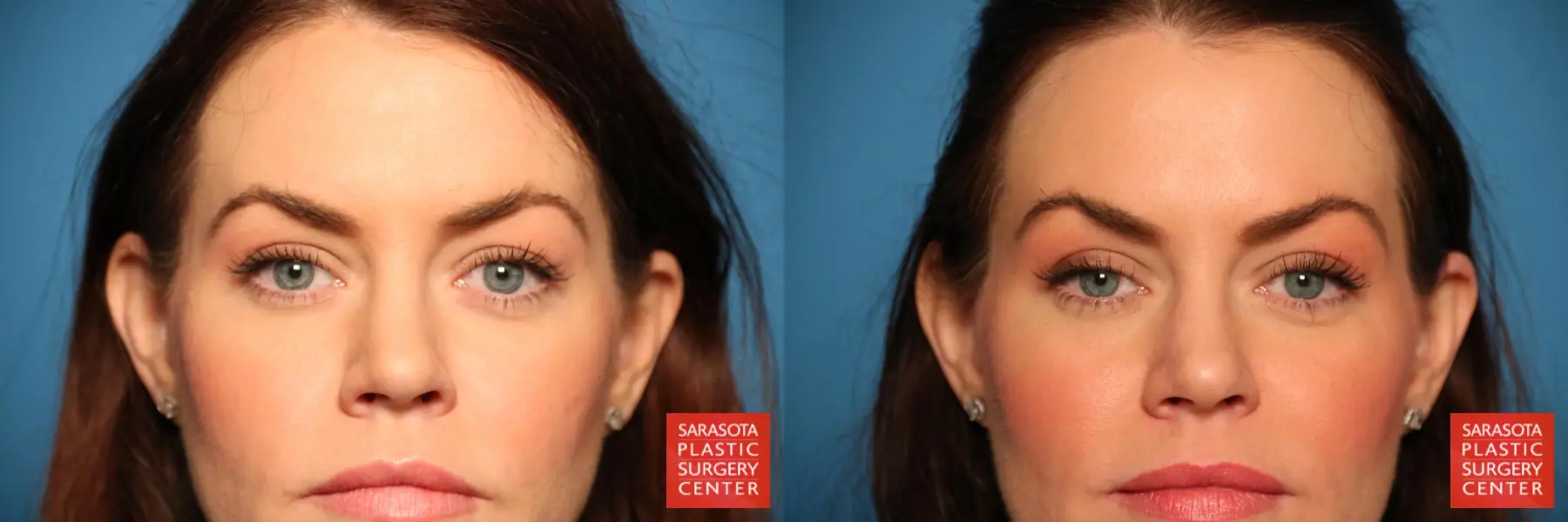 Blepharoplasty: Patient 15 - Before and After  