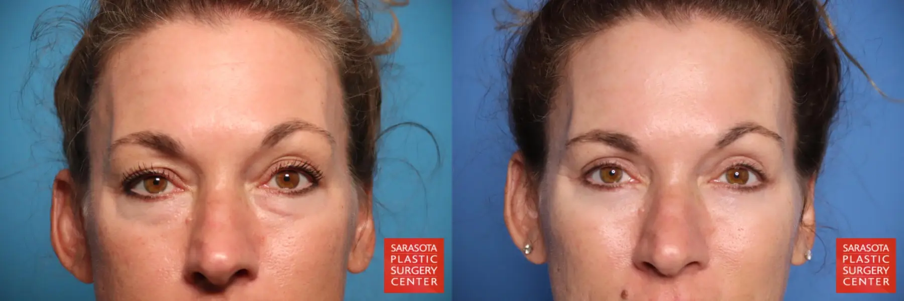 Blepharoplasty: Patient 44 - Before and After 1