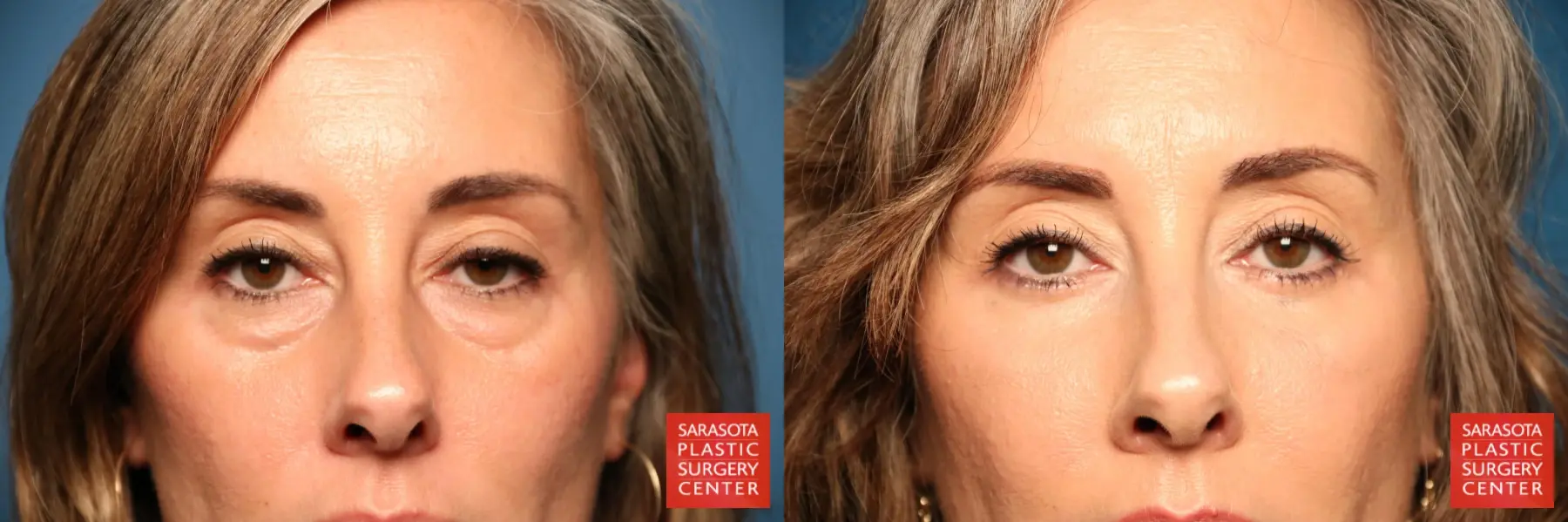 Blepharoplasty: Patient 8 - Before and After  