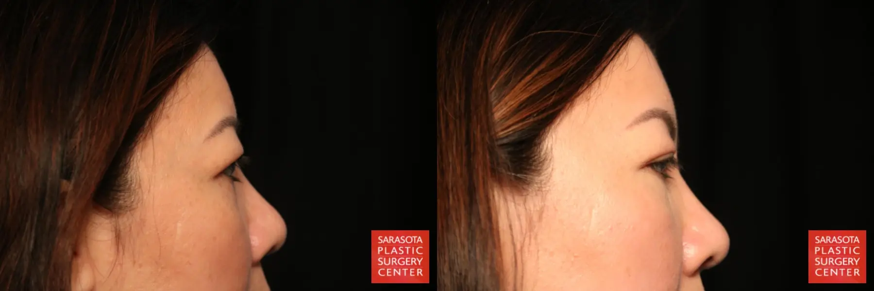 Blepharoplasty: Patient 27 - Before and After 4