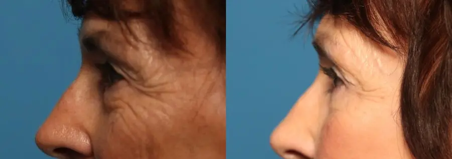 Blepharoplasty: Patient 23 - Before and After 4