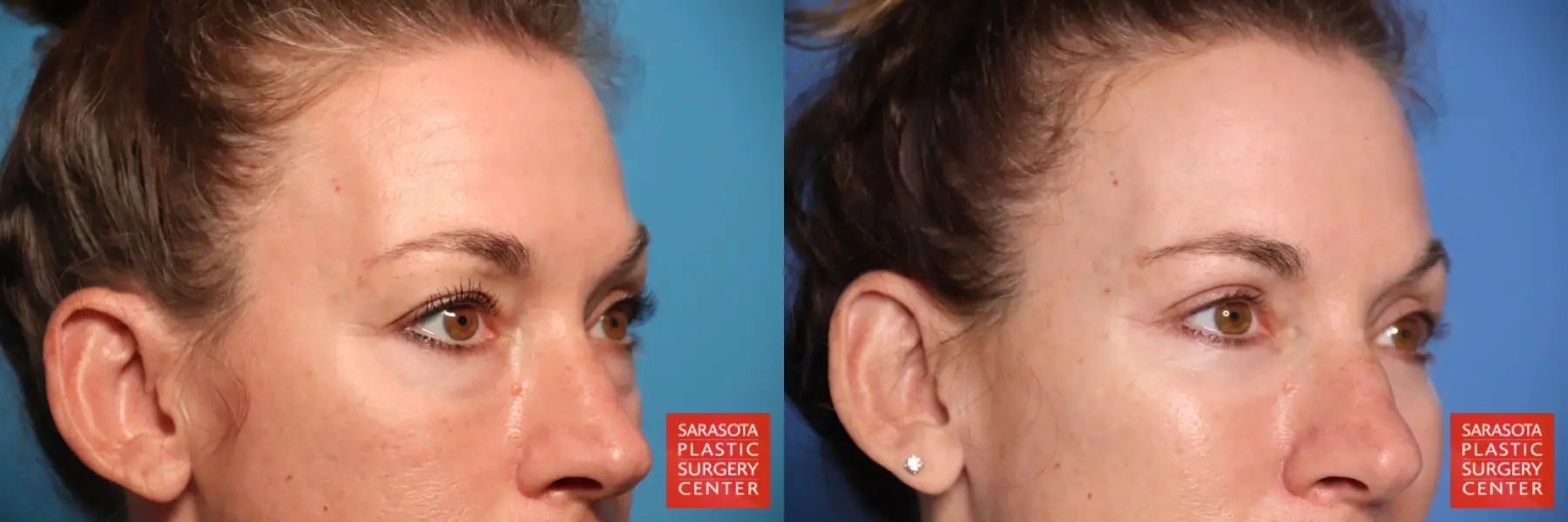 Blepharoplasty: Patient 44 - Before and After 5