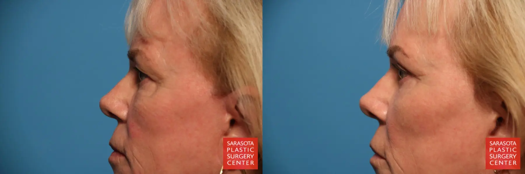 Blepharoplasty: Patient 25 - Before and After 5