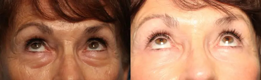 Blepharoplasty: Patient 23 - Before and After 2