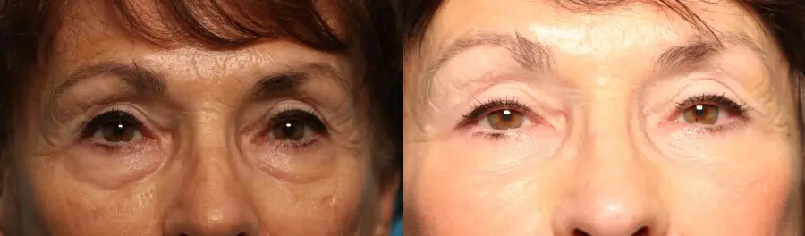 Blepharoplasty: Patient 23 - Before and After  