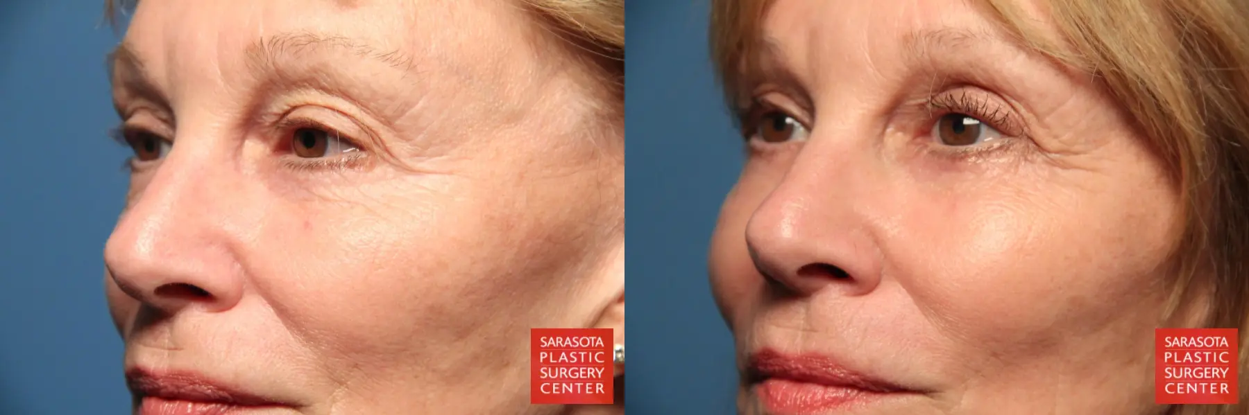 Blepharoplasty: Patient 12 - Before and After 2