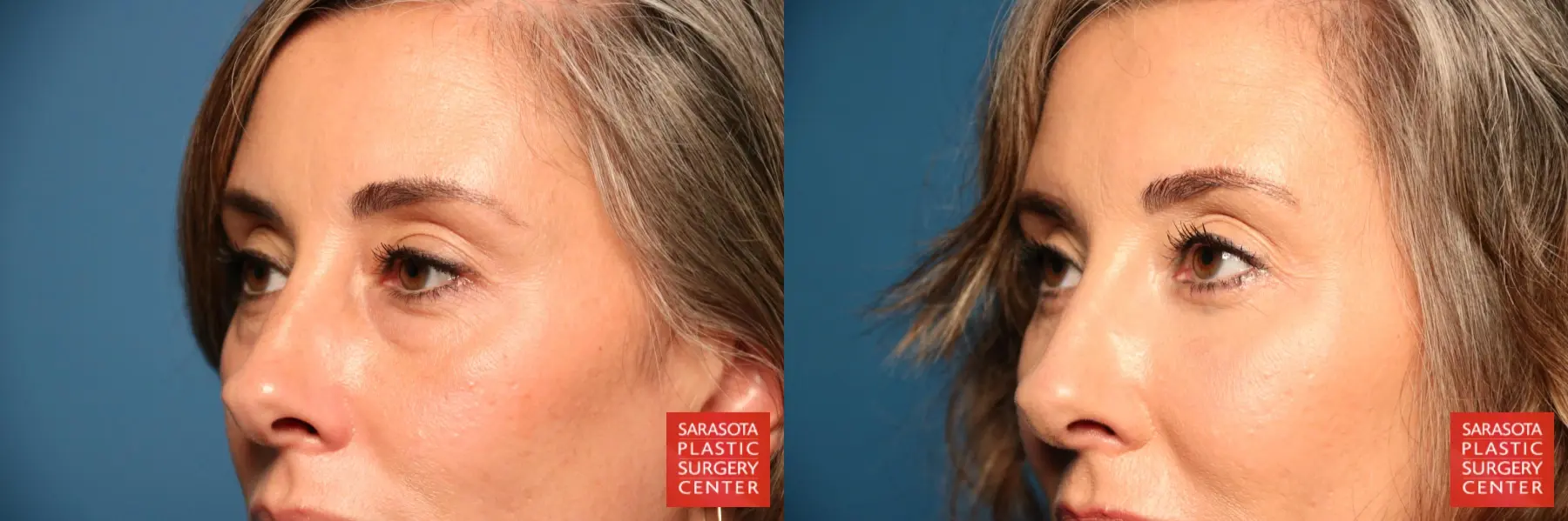 Blepharoplasty: Patient 8 - Before and After 2