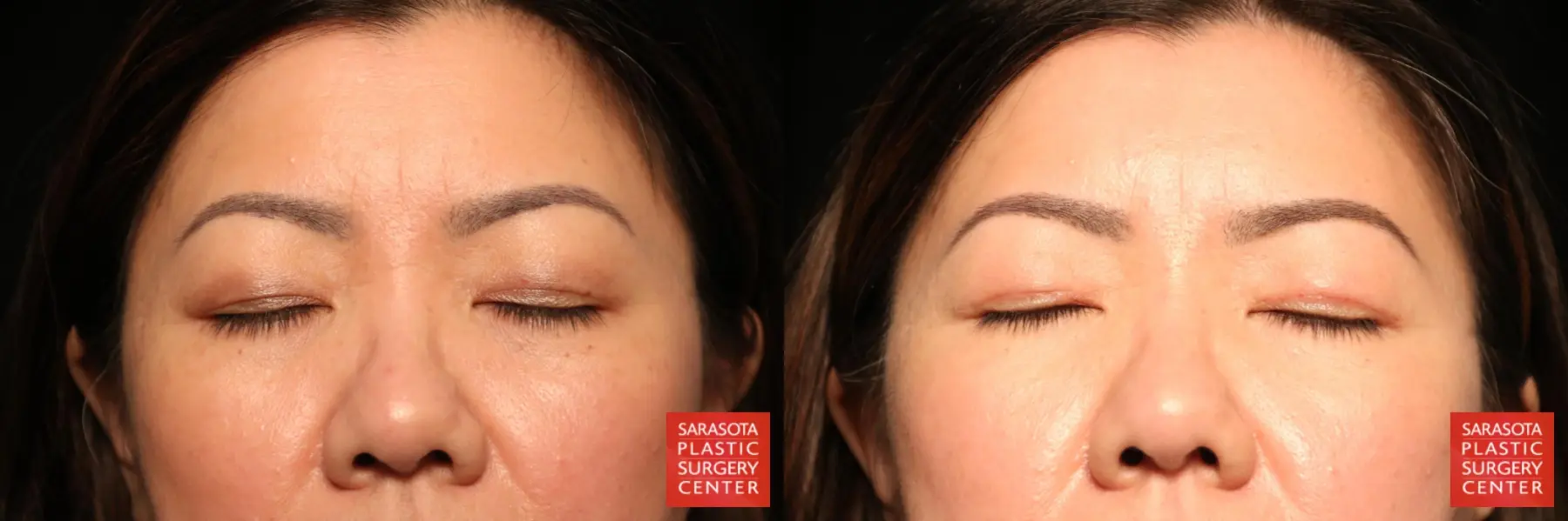 Blepharoplasty: Patient 27 - Before and After 2