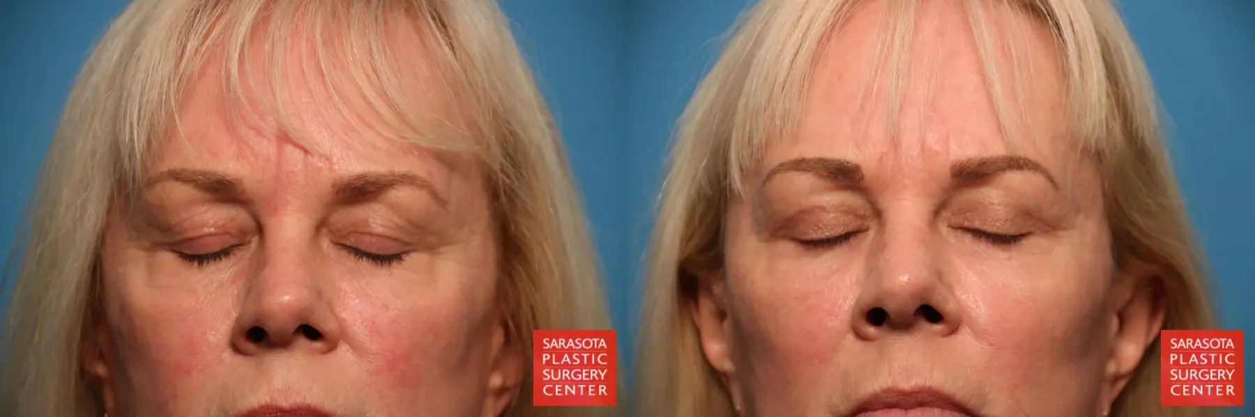 Blepharoplasty: Patient 25 - Before and After 3