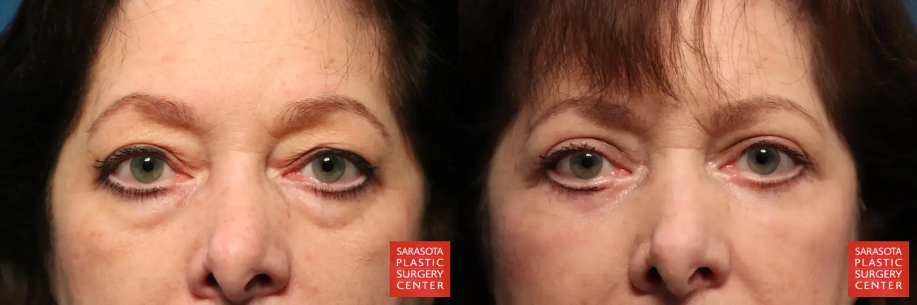 Blepharoplasty: Patient 8 - Before and After  