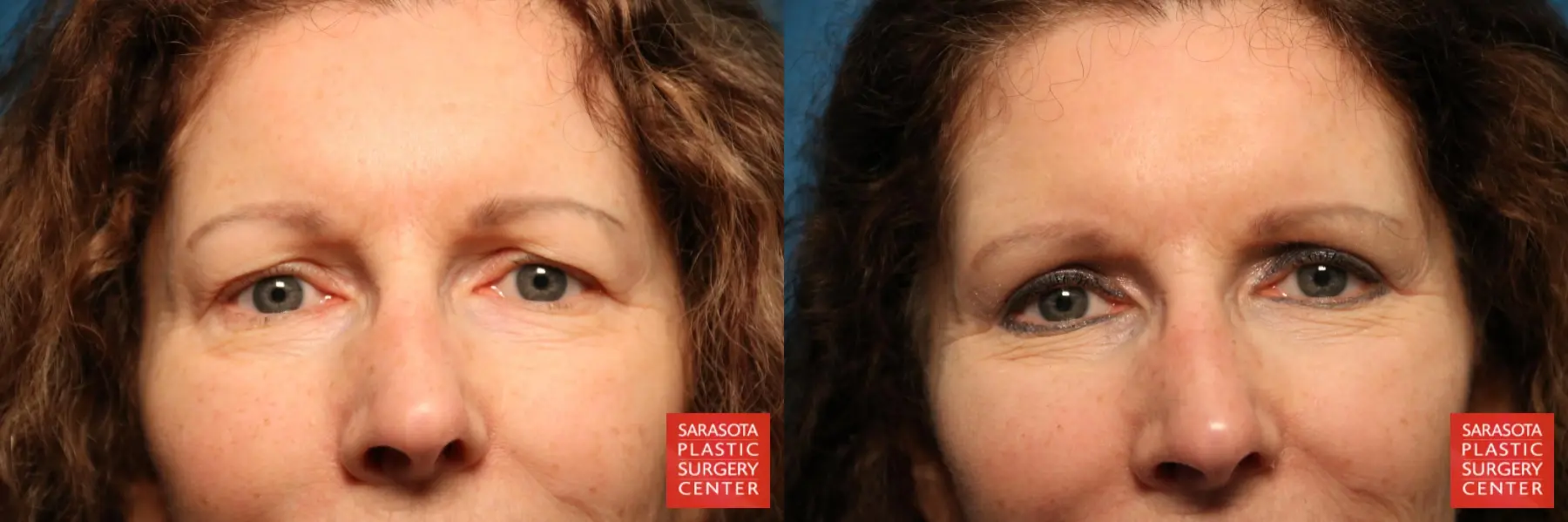 Blepharoplasty: Patient 12 - Before and After  