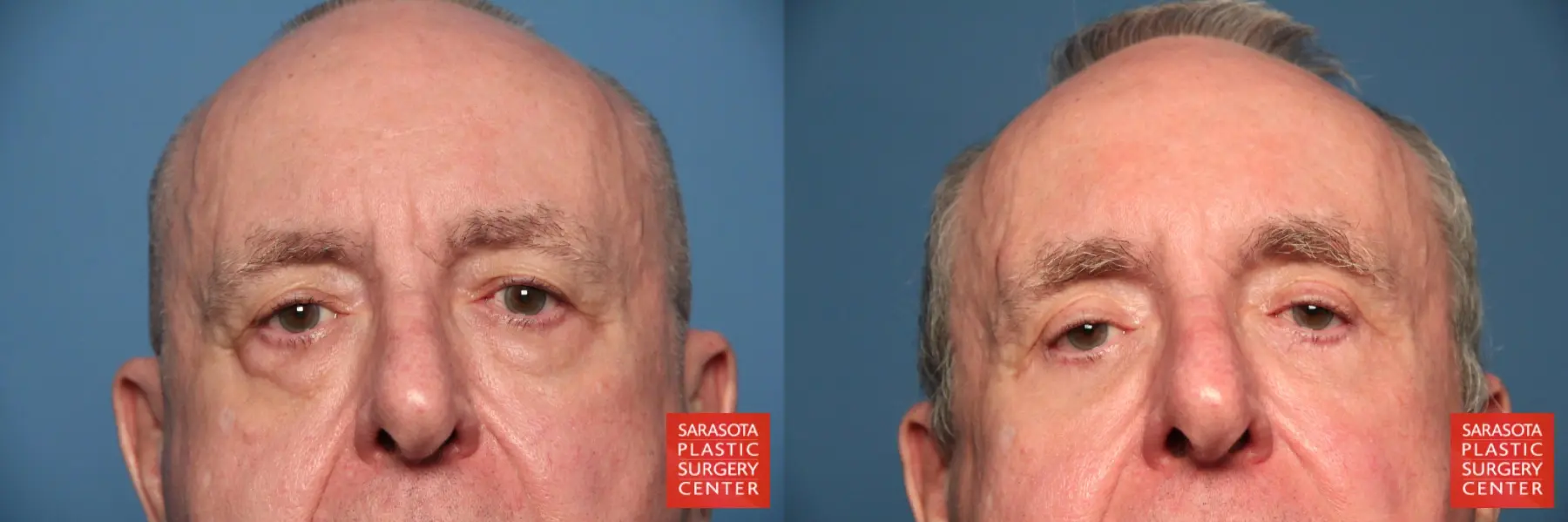 Blepharoplasty: Patient 18 - Before and After  