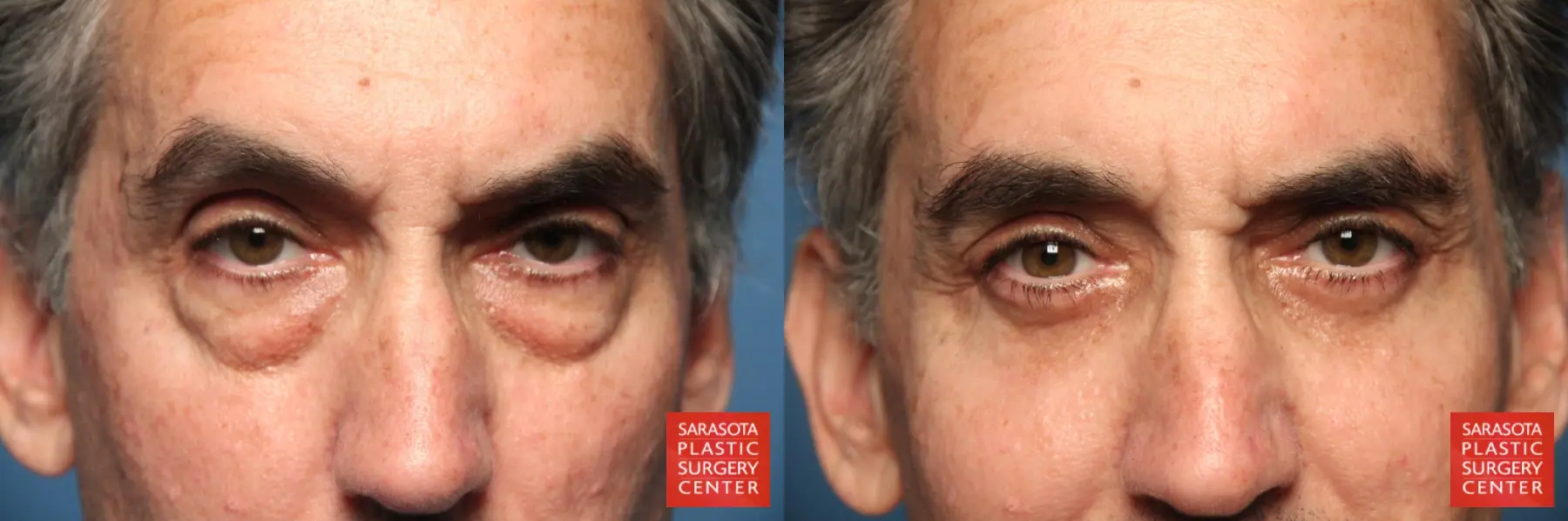 Blepharoplasty: Patient 3 - Before and After  