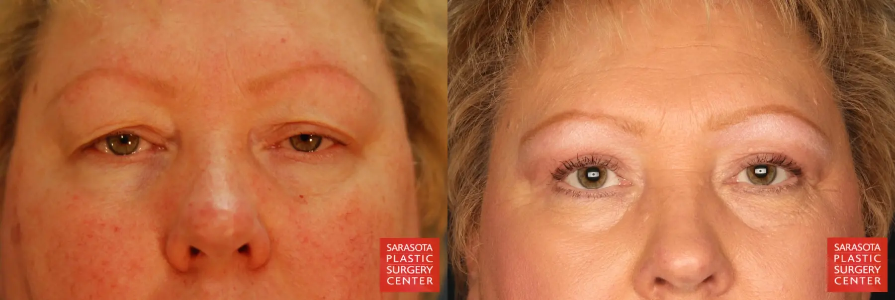 Blepharoplasty: Patient 2 - Before and After  