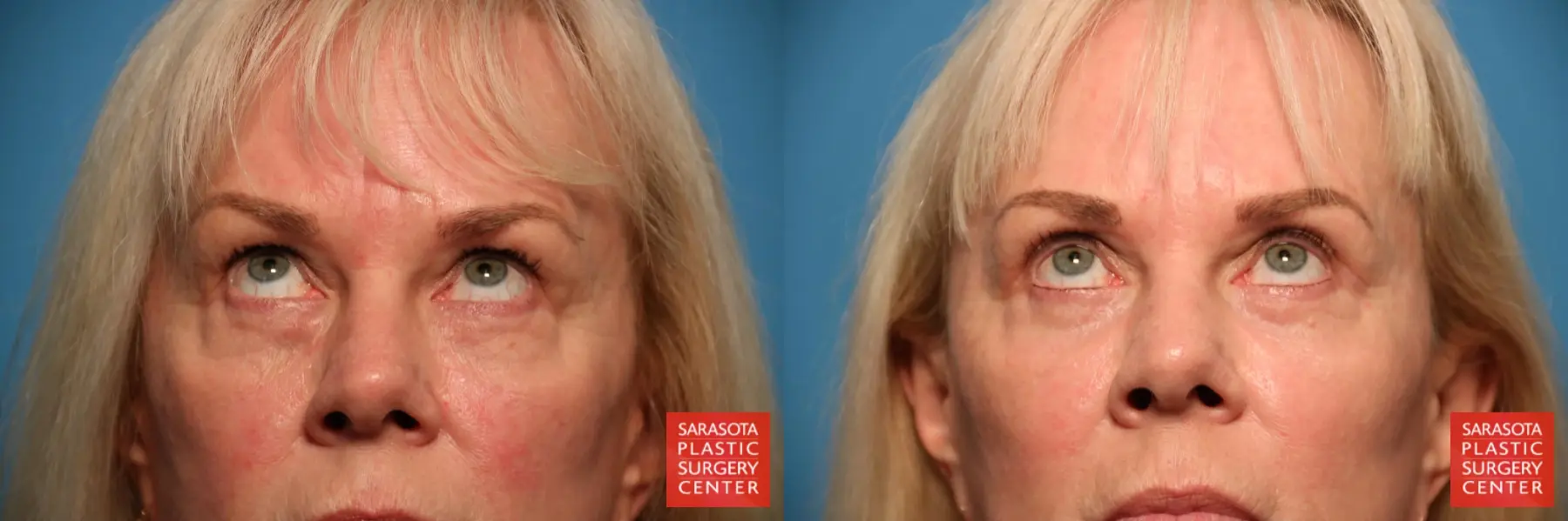 Blepharoplasty: Patient 25 - Before and After 2