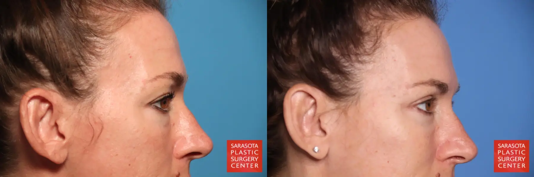 Blepharoplasty: Patient 44 - Before and After 6