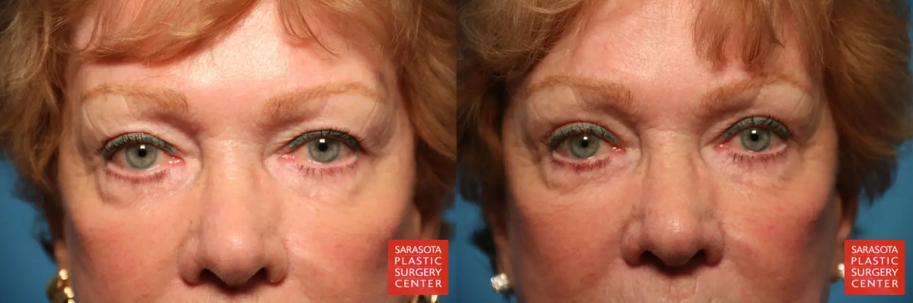 Blepharoplasty: Patient 25 - Before and After  