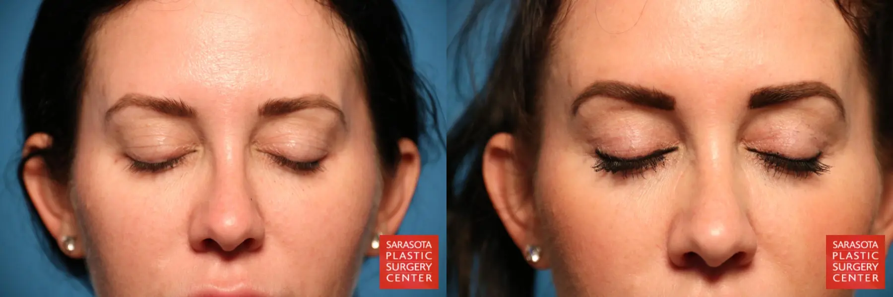 Blepharoplasty: Patient 11 - Before and After 2