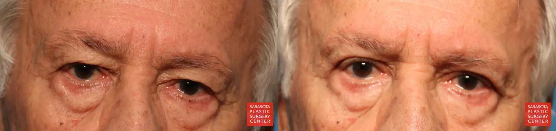 Blepharoplasty: Patient 21 - Before and After  