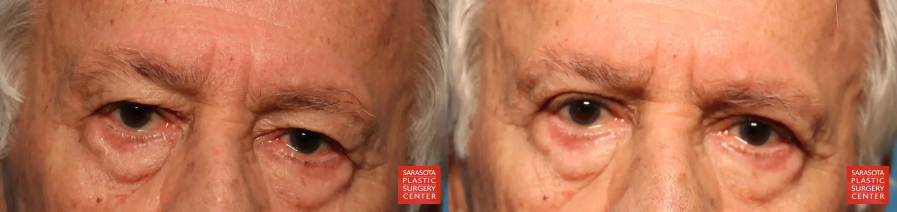 Blepharoplasty: Patient 22 - Before and After  