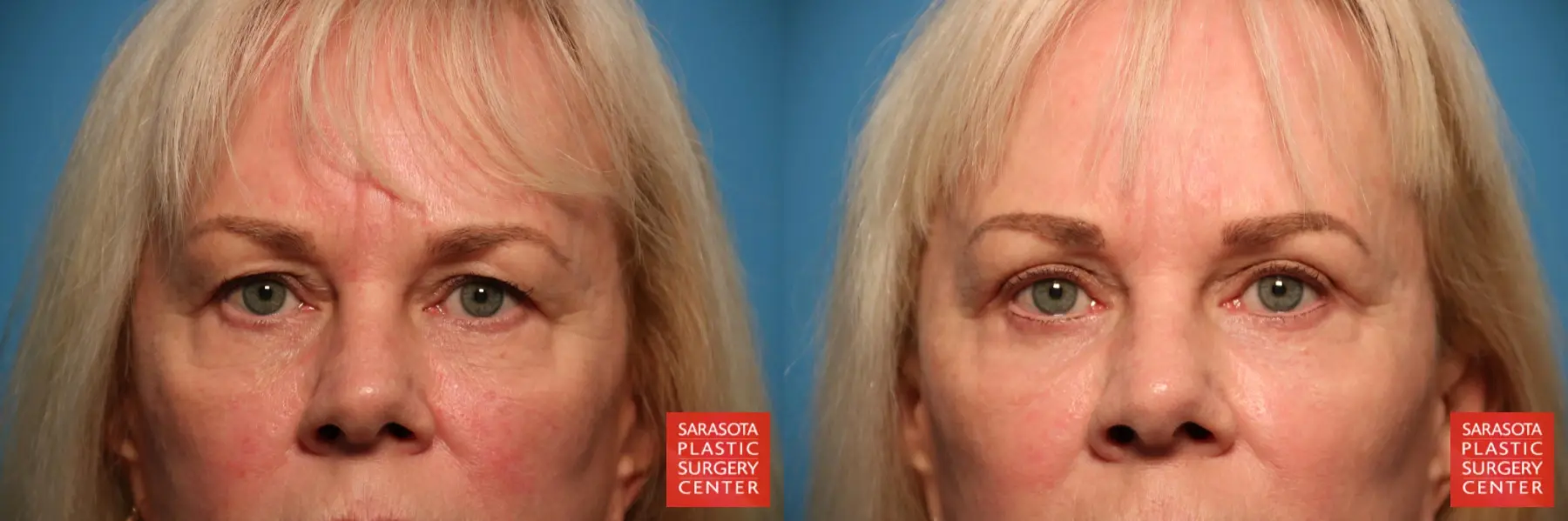 Blepharoplasty: Patient 25 - Before and After  