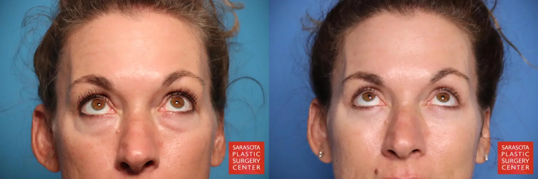 Blepharoplasty: Patient 44 - Before and After 2