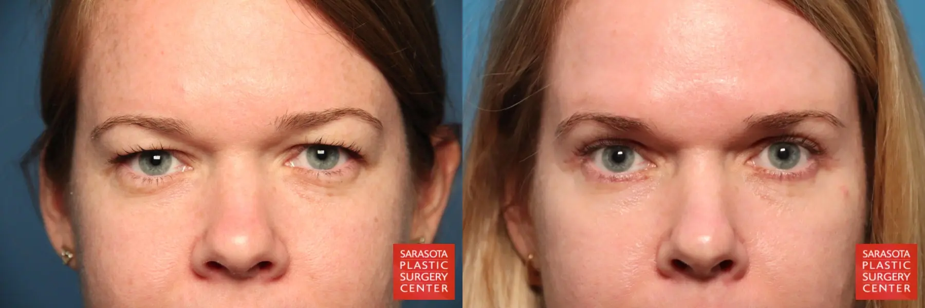 Blepharoplasty: Patient 27 - Before and After  